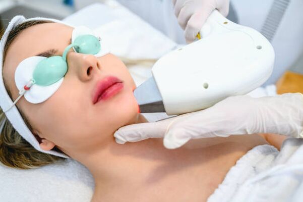 laserski postopek pomlajevanja kože obraza