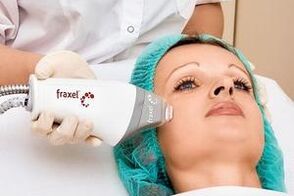 lasersko frakcijsko pomlajevanje kože obraza