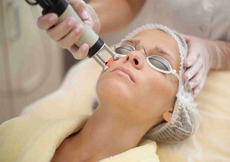 Laserski postopek pomlajevanja kože okoli oči