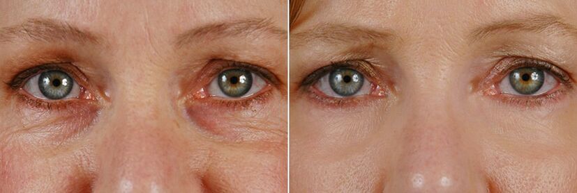 Pred in po laserski operaciji - pomlajevanje kože okrog oči