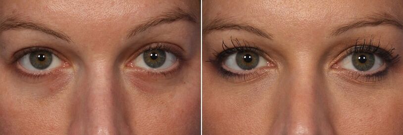 Pred in po uporabi injekcijskih polnil - zmanjšanje kolobarjev pod očmi